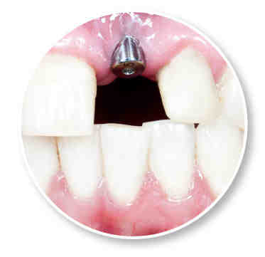 What should I do after abutment surgery?