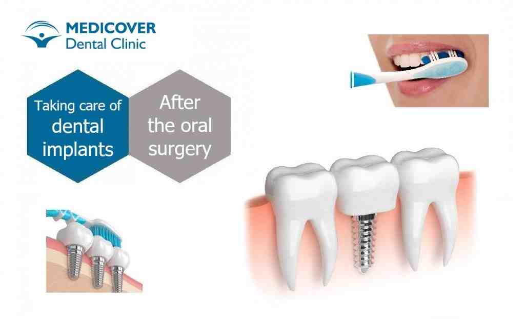 What specialist is best for dental implants?