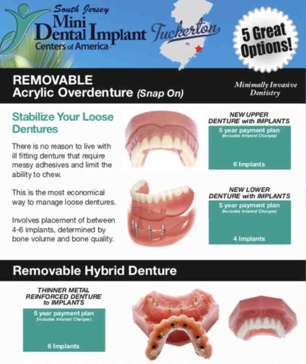 What they don't tell you about dental implants?