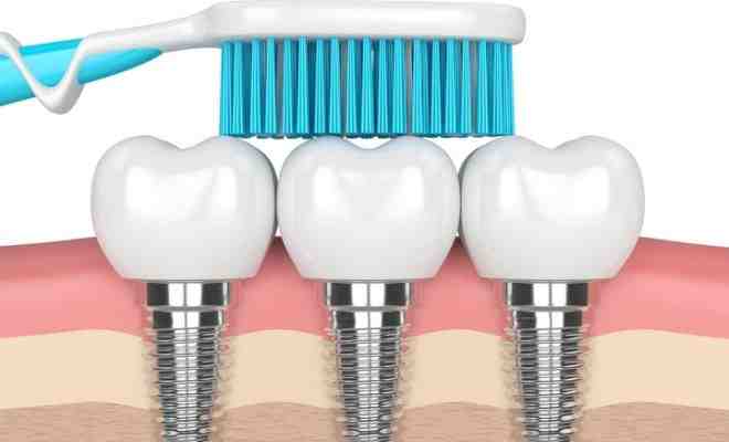 What they don't tell you about dental implants?