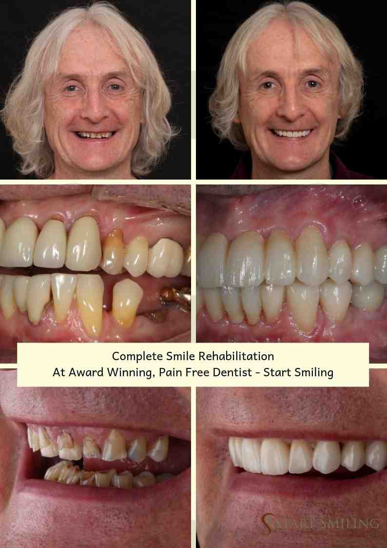 What they don't tell you about dental implants?