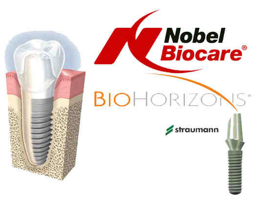 What they don't tell you about dental implants?