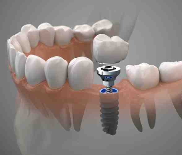 What they don't tell you about dental implants?