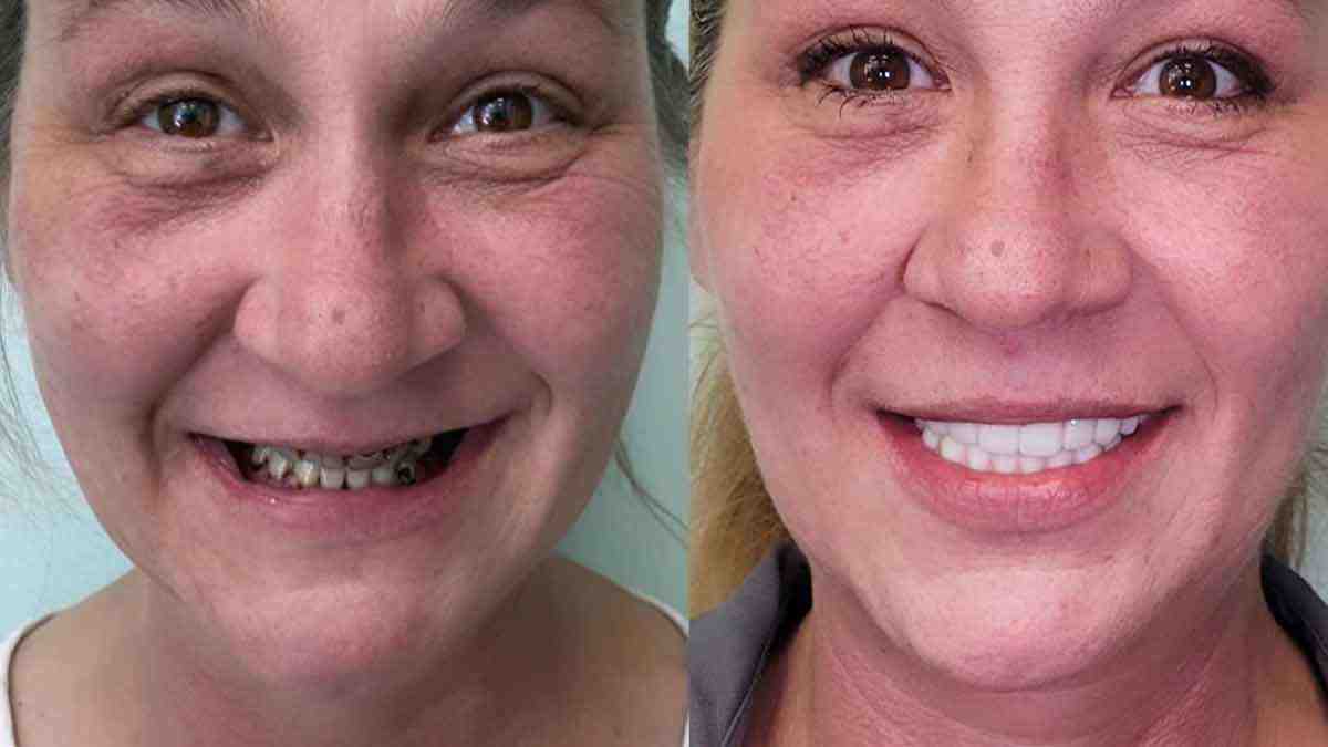 What they don't tell you about dental implants?