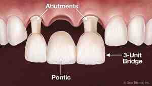 What they don't tell you about dental implants?