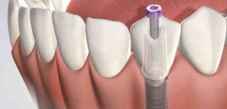 What to ask about dental implants