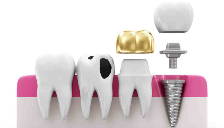 What to do if a dental implant comes out