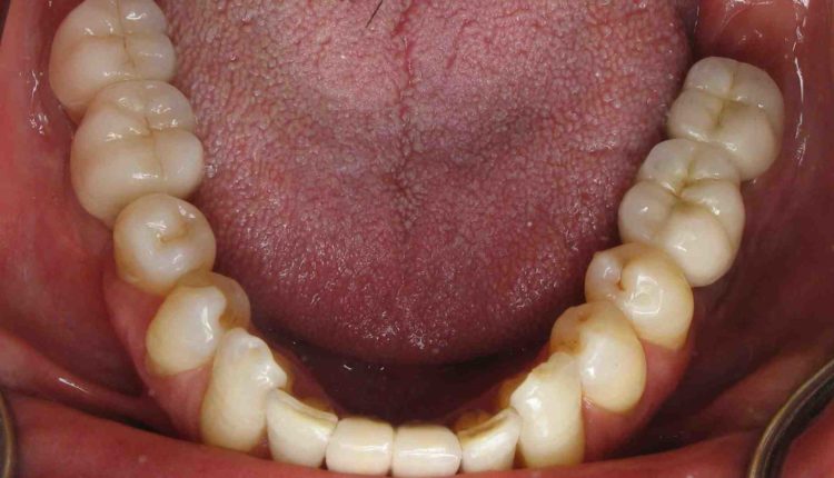 What to do if dental implant crown becomes loose