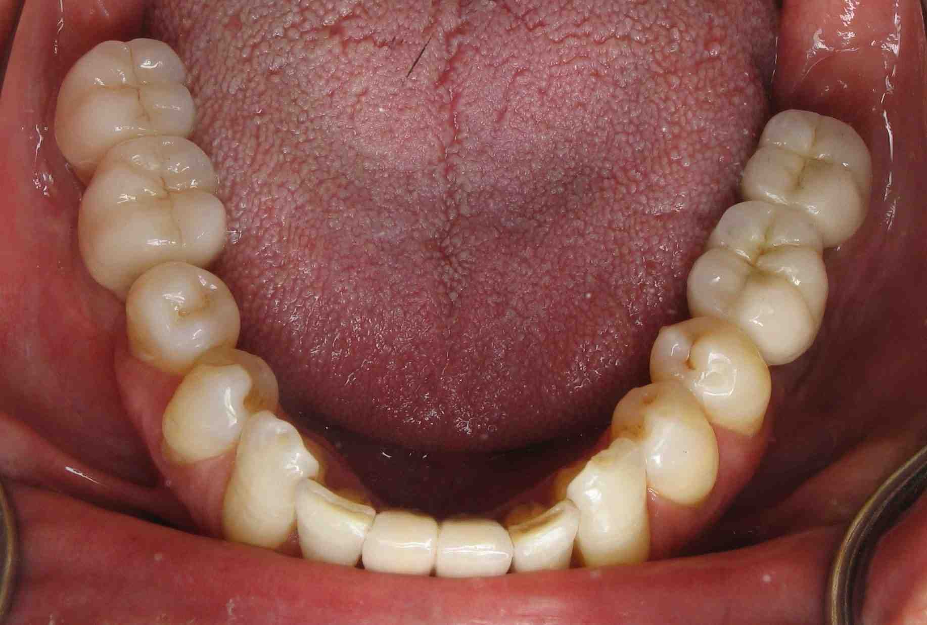 what-to-do-if-dental-implant-crown-becomes-loose-dental-news-network