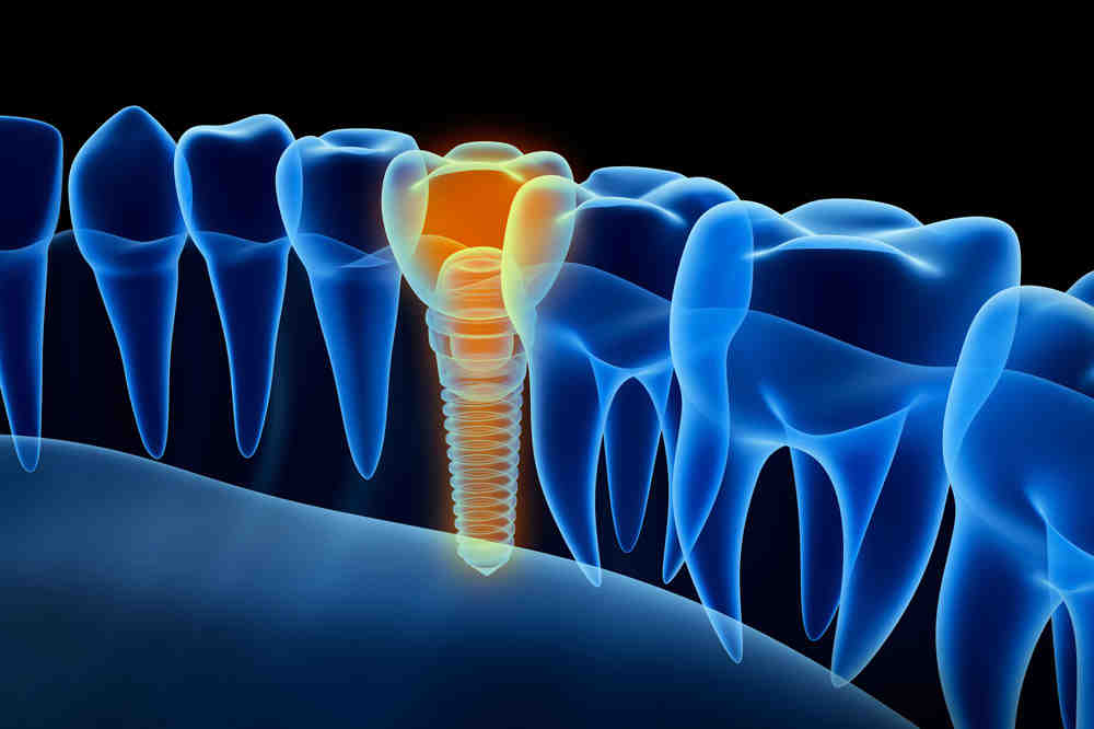 What toothpaste is best for implants?