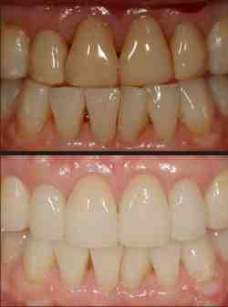 What's better Lumineers or veneers?