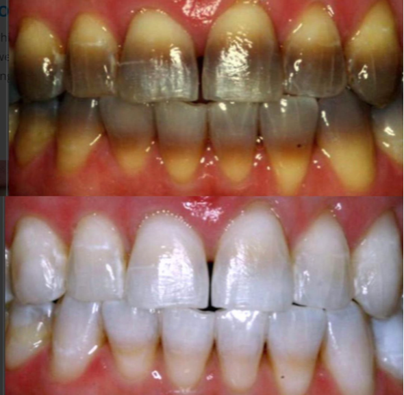 What's the average time you wear braces?