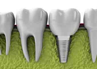What's the cheapest way to fix my teeth?