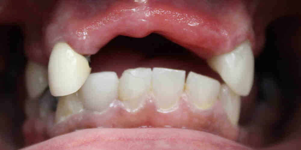 What's the next best thing to dental implants?