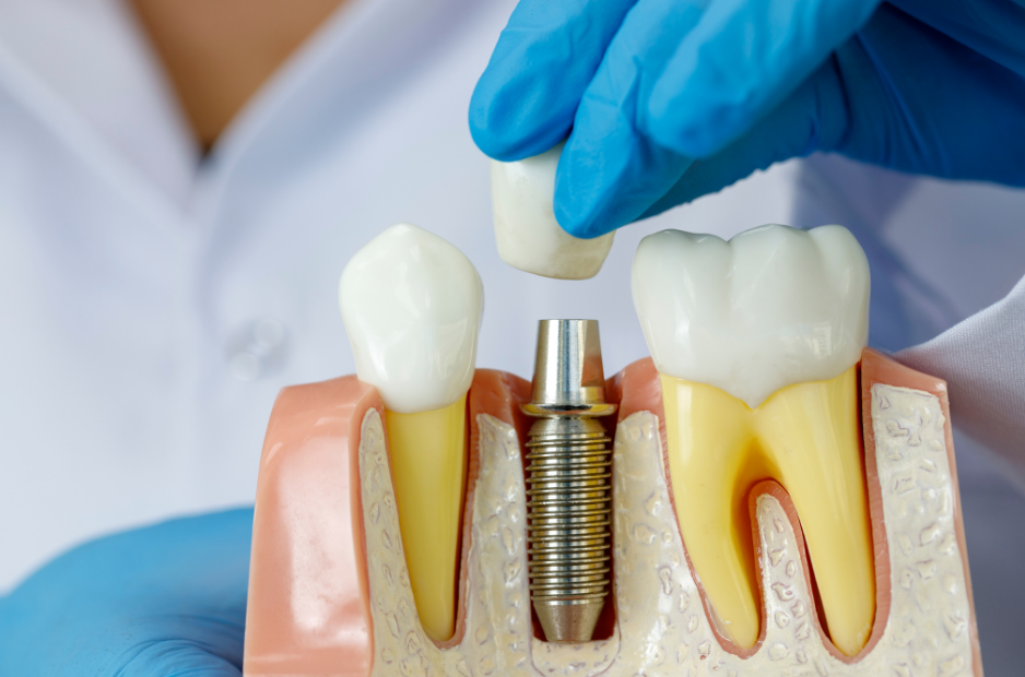 What's the pros and cons of dental implants?