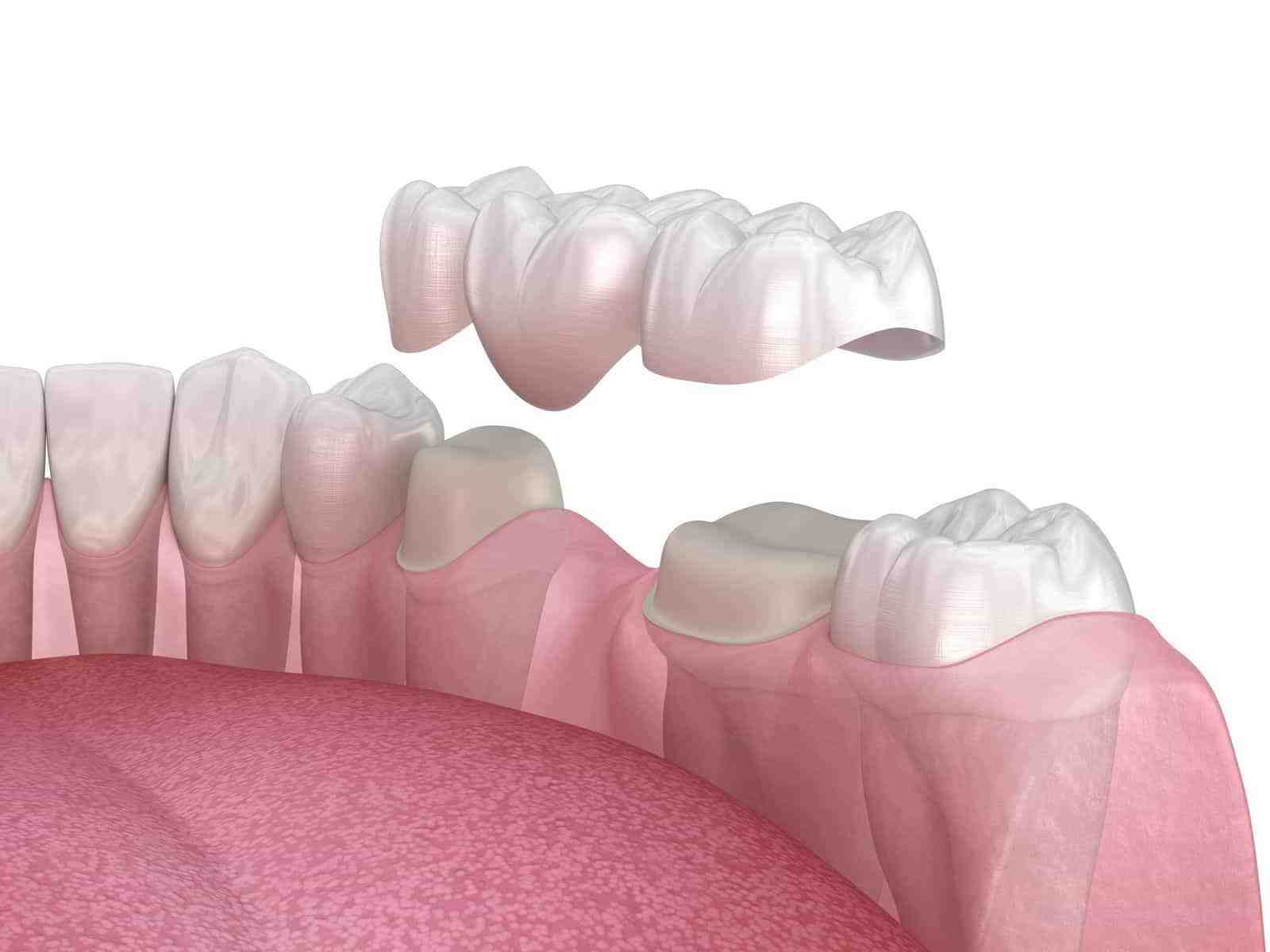 When are implants not recommended?