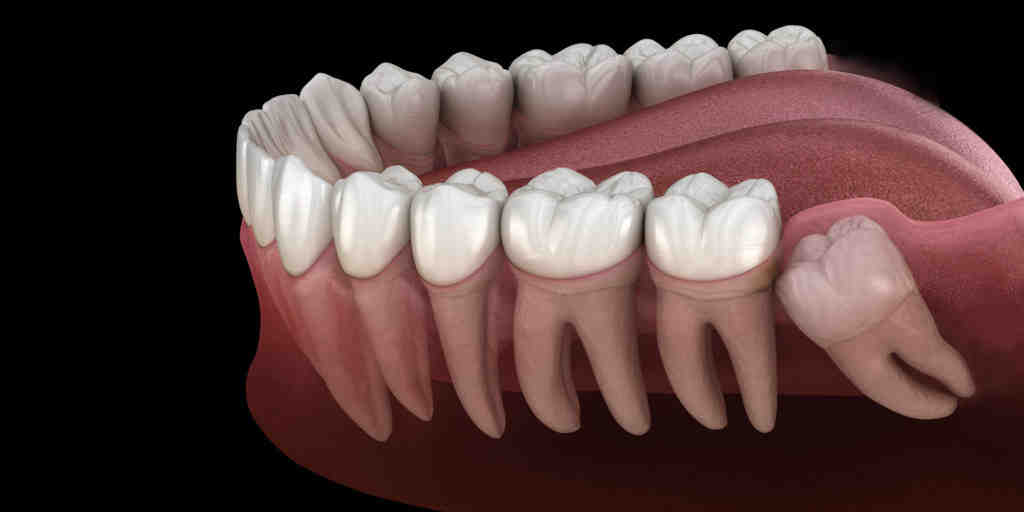 When can I drink soda after a bone graft?