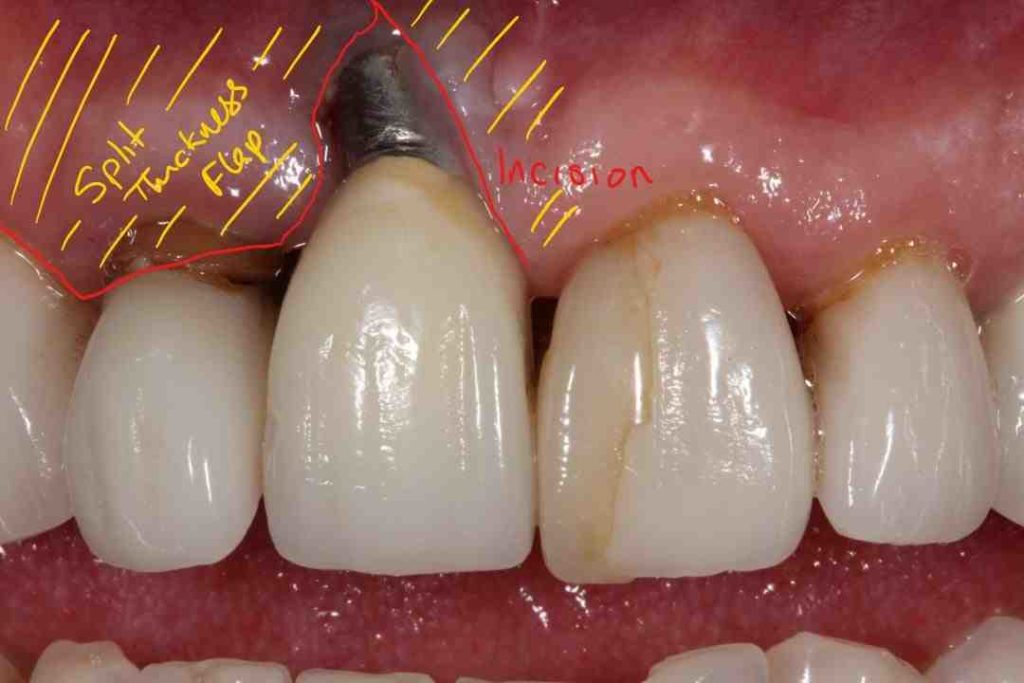 When can sutures be removed in a dental implant Dental News Network