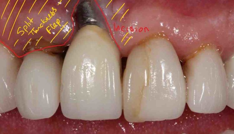 When can sutures be removed in a dental implant