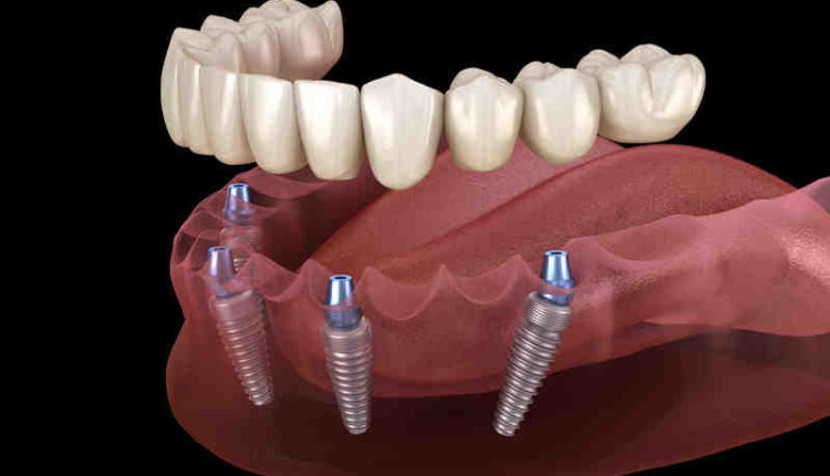When did they start making dental implants