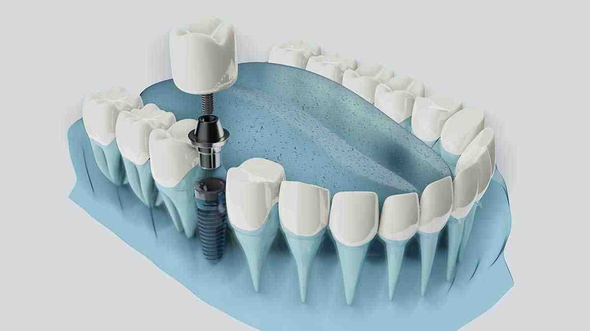 When should you not get dental implants?