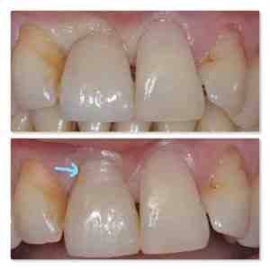 When should you not get dental implants?