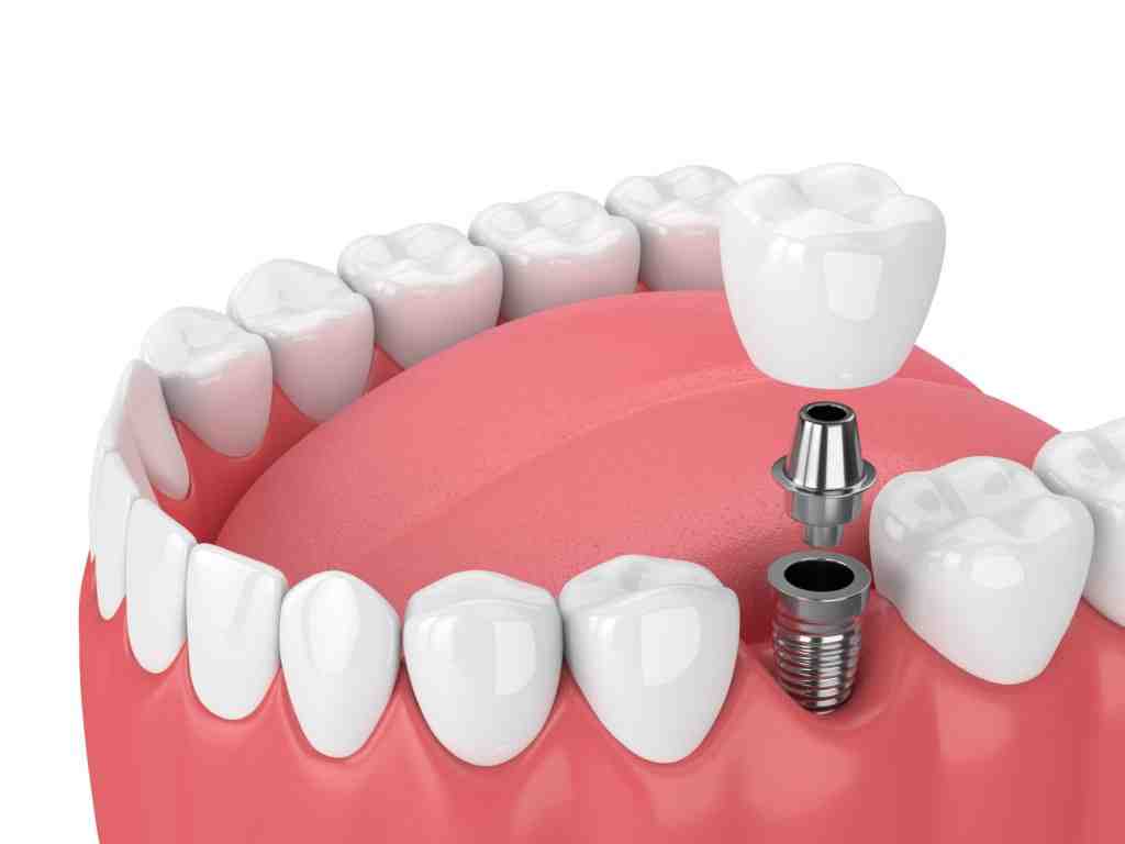 When should you not get dental implants?