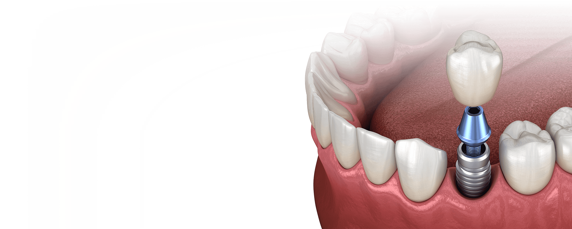 When should you not get dental implants?