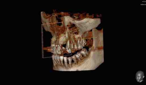 Where does bone come from for dental implants?