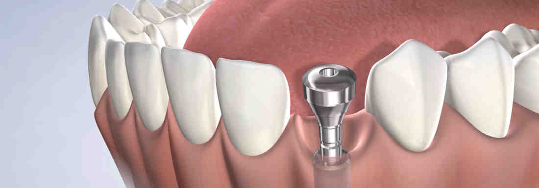 Where in the world are dental implants cheapest?