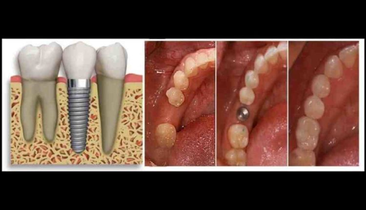 Where is the least expensive dental implant procedure performed?