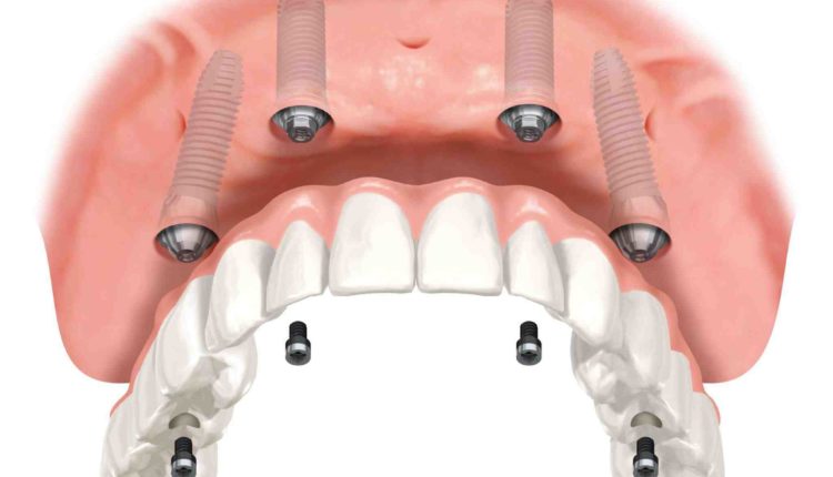 Where to get dental implants in tulsa