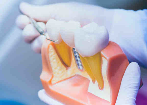 Where to get dental implants pulaski va