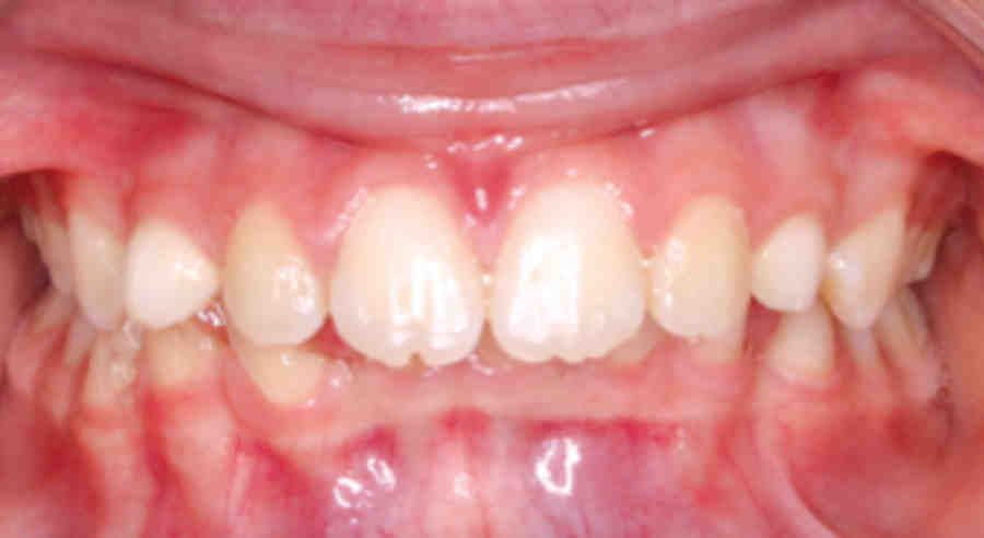 Which bone graft is best?