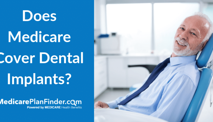 Which dental insurances pay for implants