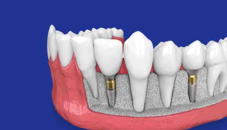 Which dentist does dental implants