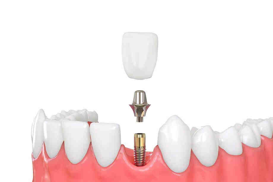 Which is better a root canal or an implant?