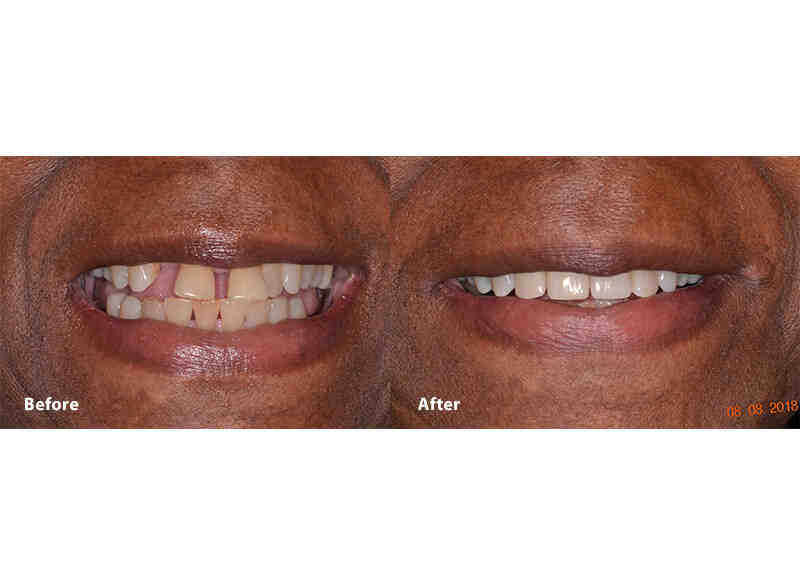 Which is better implant or bridge?