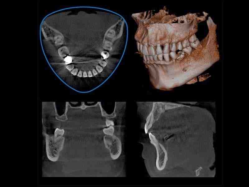 Which type of imaging is best for improved diagnosis and treatment planning of an implant case?