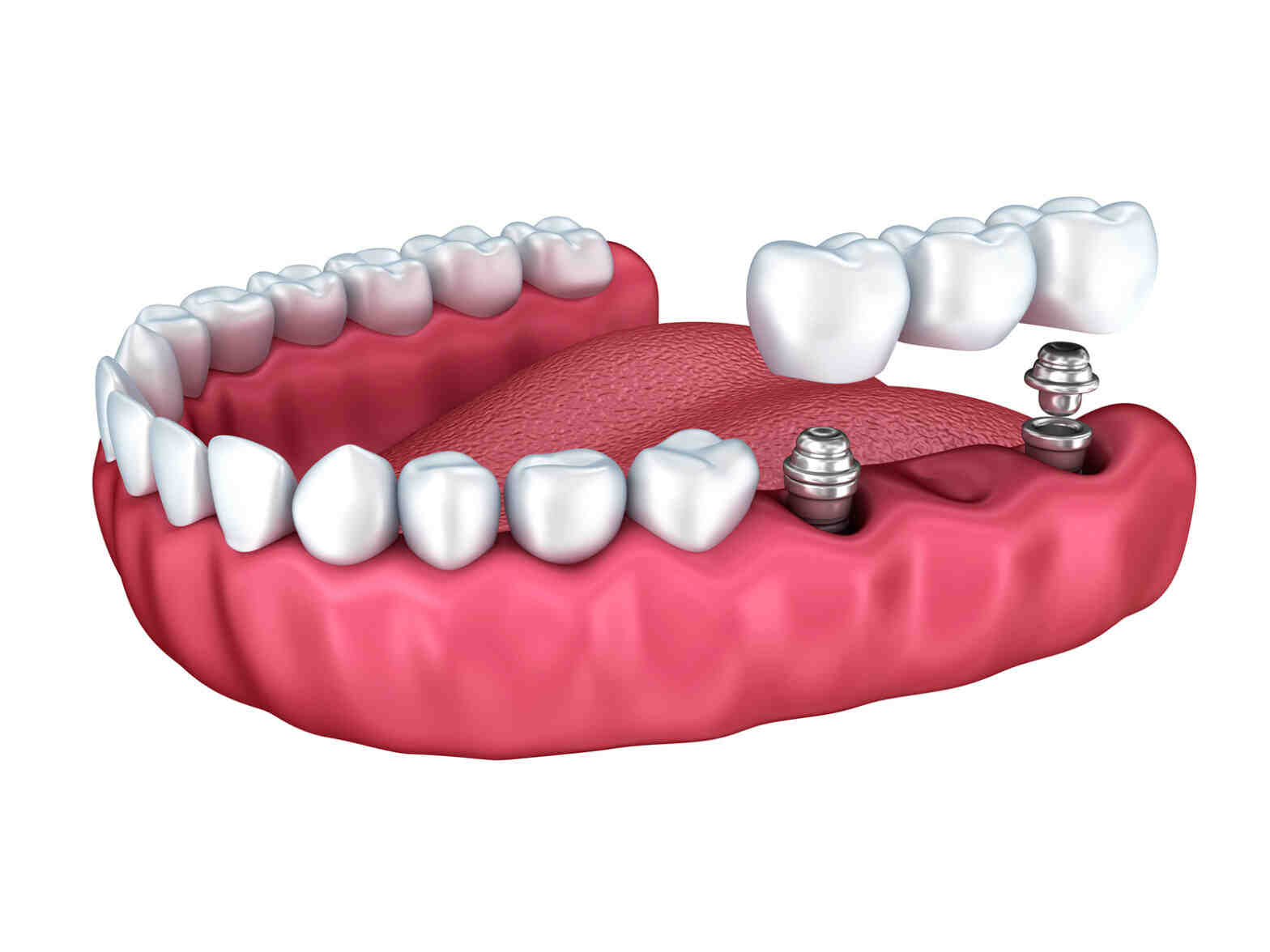 Which type of implant is most commonly used?