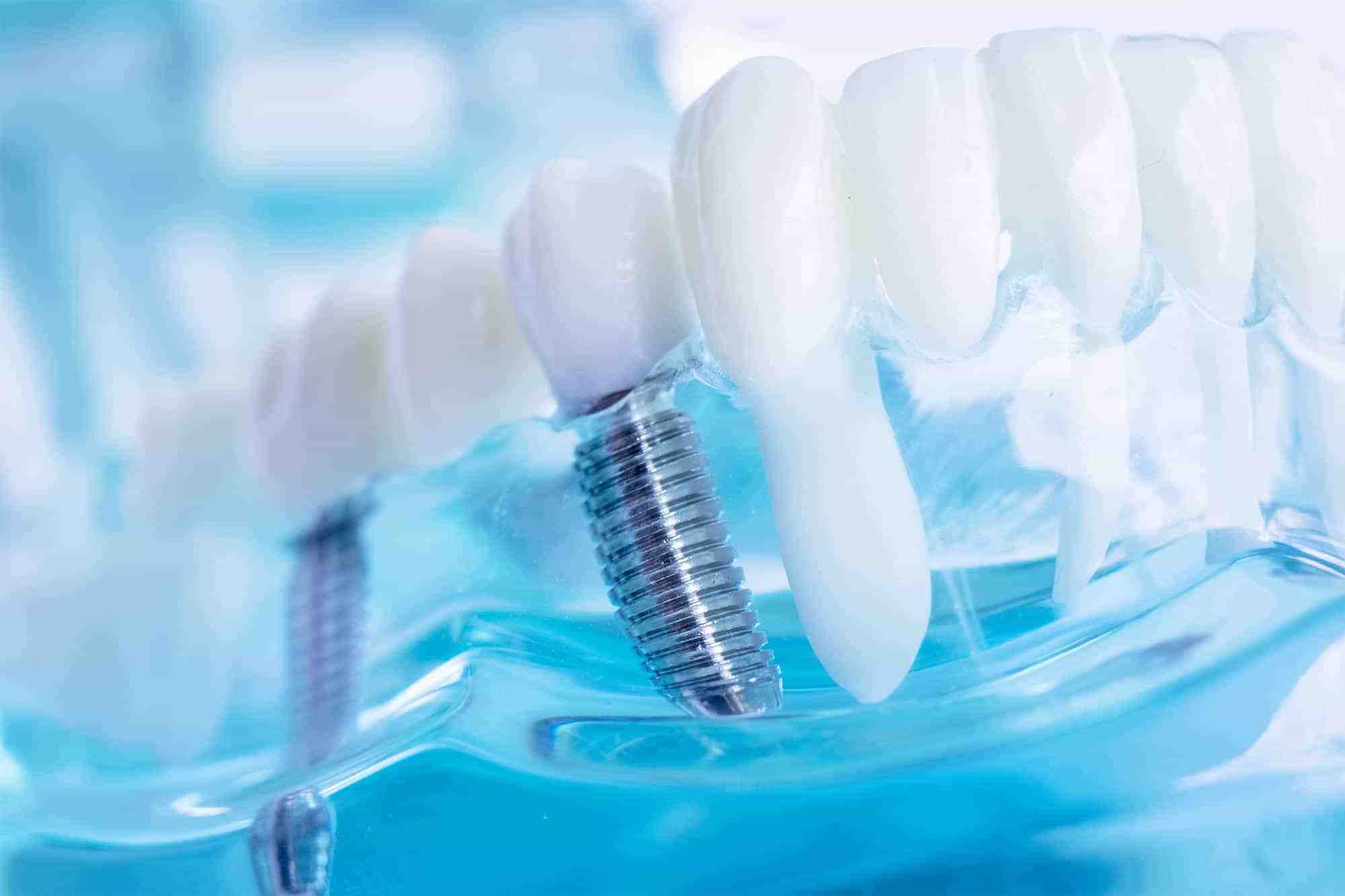 Which type of implant is most commonly used?