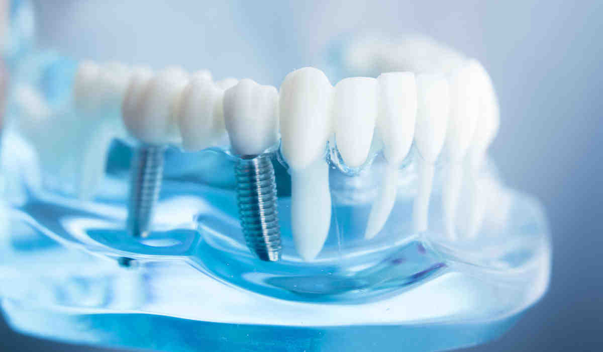 Who Cannot have dental implants?