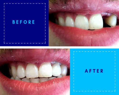 Who is not a good candidate for dental implants?