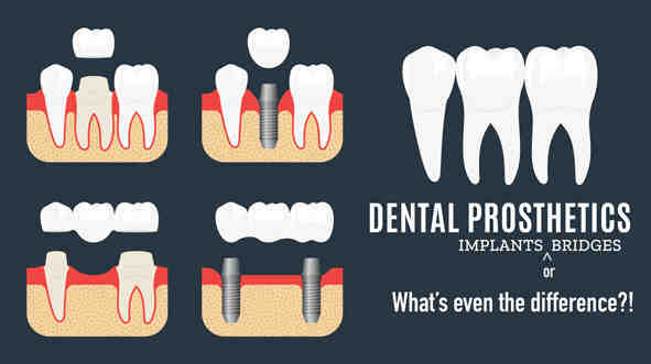 Who is not a good candidate for dental implants?