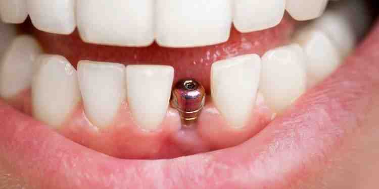 Who is not suitable for dental implants?