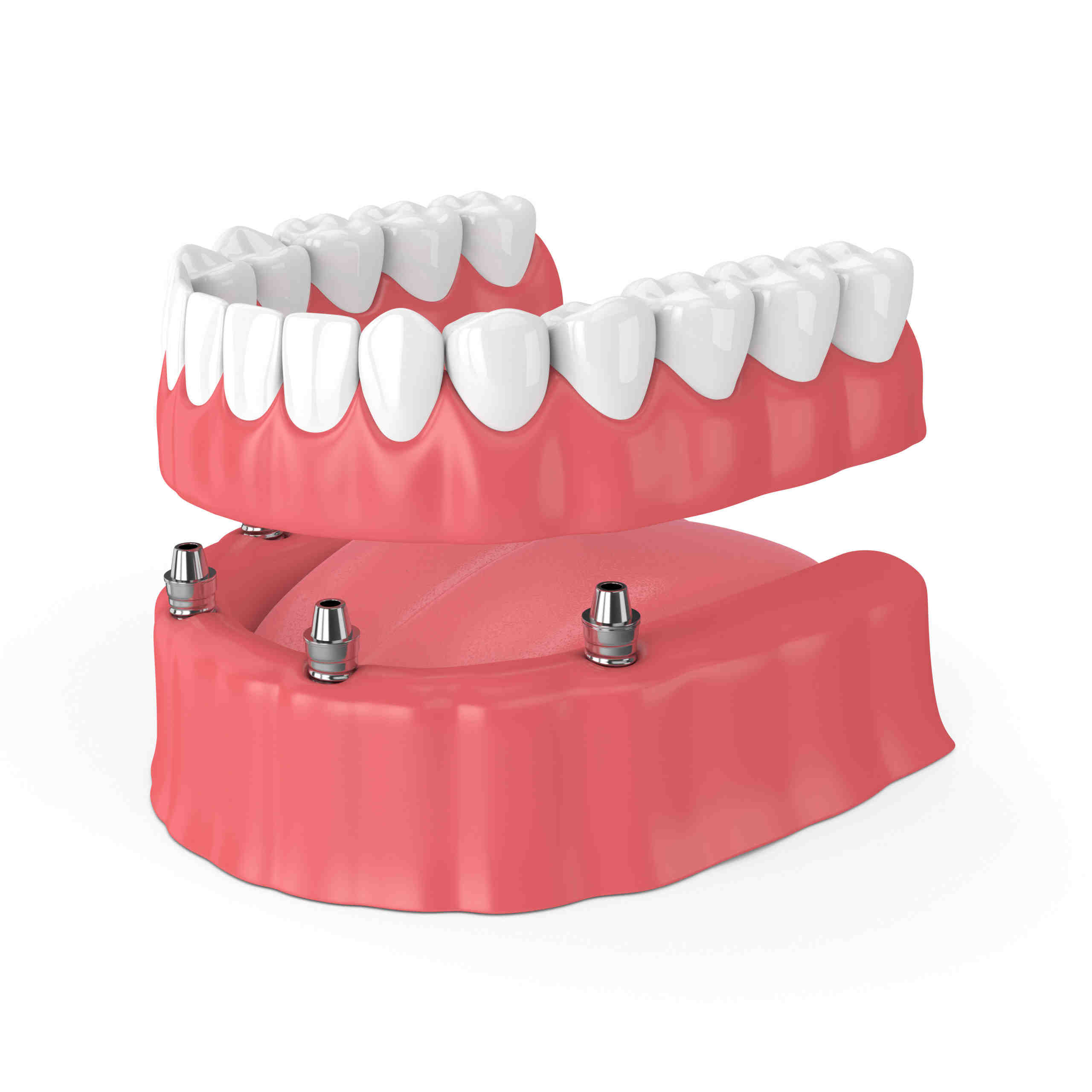 Who is not suitable for dental implants?