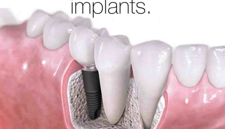 Who needs dental implants