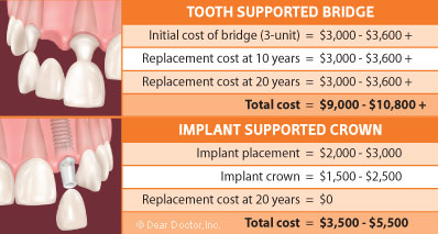 Who should get a dental bridge?