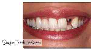 Who should not get an implant?