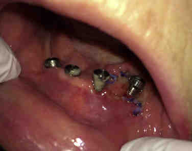 Who should not get an implant?